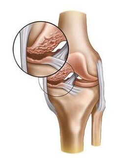 Injured cartilage