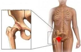 Causes of the formation of arthrosis of the hip joint