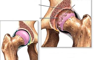 Diagnosis of the hip of the hip