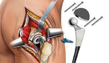 Endoprostanika hip joint