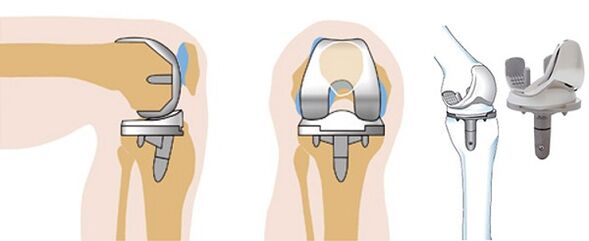 The knee joint endoprostetics function for arthrosis