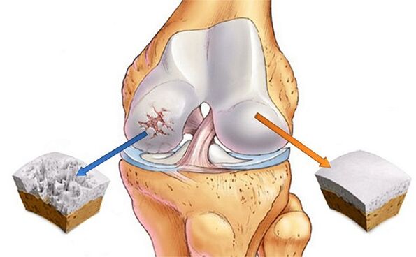 the norm and difference of arthrosis of the knee joint