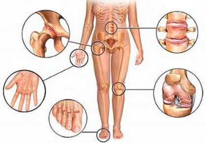Arthritis and various joints joints