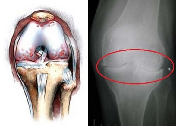 Deformation of the knee joint from a joint joint
