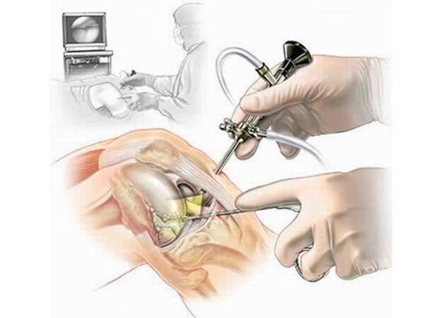 The arthroscopy of the knee joint