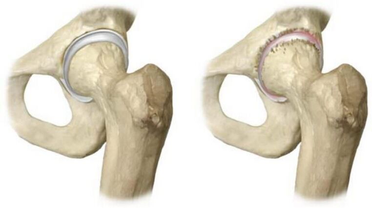 healthy hip joint and necrosis of the head as the cause of pain