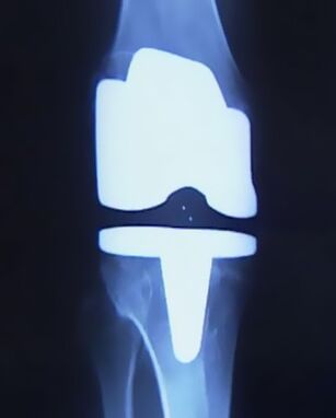 X-ray of the knee with an artificial prosthesis after joint replacement