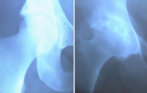 picture of arthrosis of the knee joint