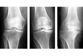 stages of arthrosis of the joint on X-ray