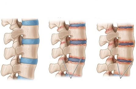 ankylopathy of spondylitis