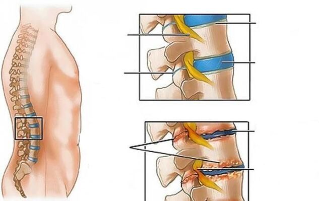 lumbar spine osteochondrosis has back pain