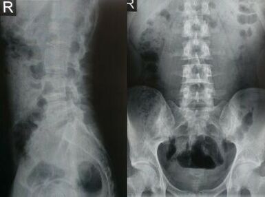 radiography of the lumbar spine